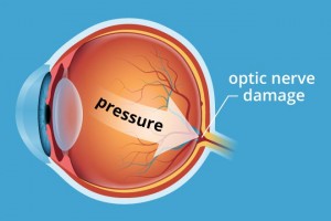glaucoma-pressure-330x220@2x
