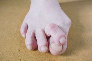 Deformity of toes